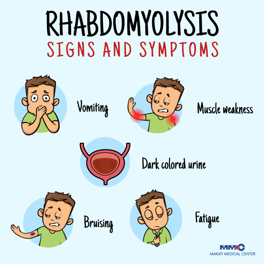 Signs and symptoms of Rhabdomyolysis